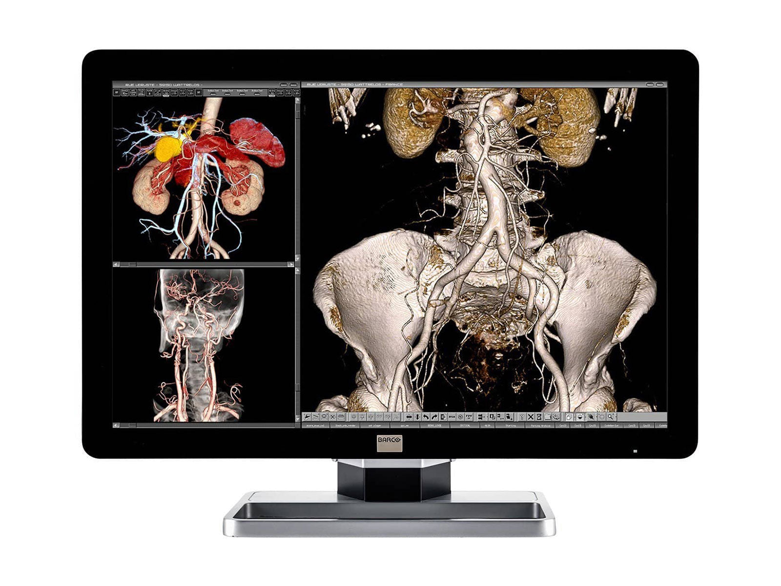 Barco Coronis Fusion MDCC-6230 6MP 30" Color LED General Radiology PACS Display