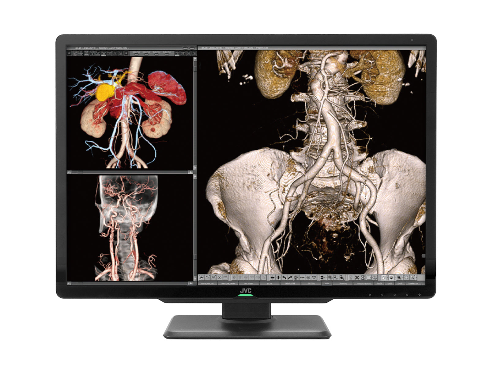 Komplette PACS-Station für allgemeine Radiologie | JVC Totoku 6MP Farbdisplay | HP Z4 G5 Workstation | Diktiermikrofon | Arbeitsvorratsmonitor (S600Z4G5)