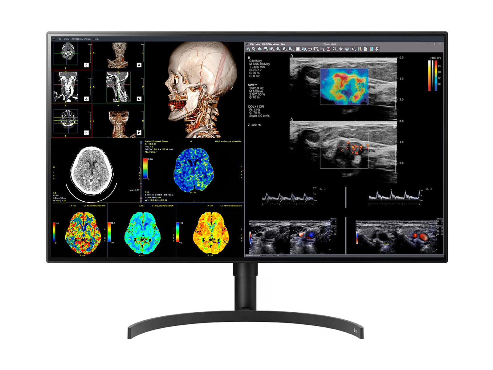 LG 8MP Fusion 4K 32" Color Medical Diagnostic Radiology Monitor 450 cd/m² DICOM Brightness (32HL512D-B)
