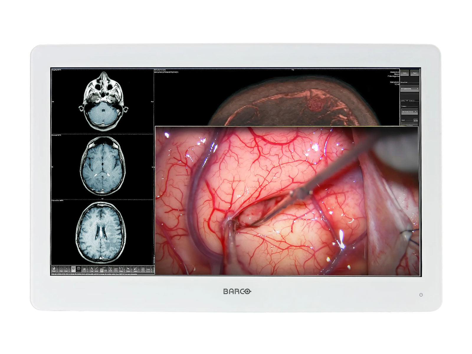 Barco MDSC-8232 Moniteur d’affichage médical chirurgical couleur LED 4K 32" 8MP (K9307922)