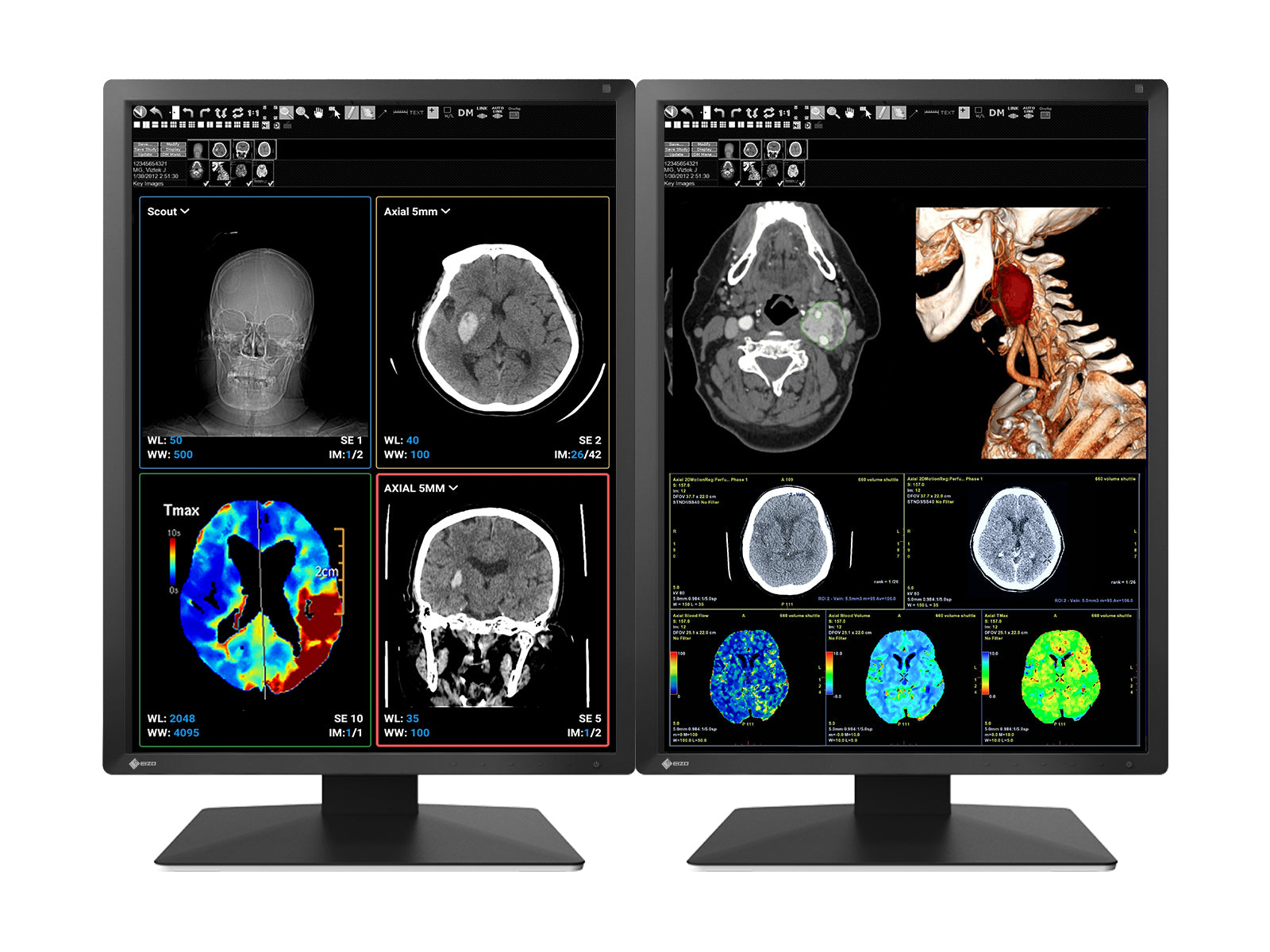 Eizo RadiForce MX217 2MP Color LED Diagnostic Monitor (MX217 