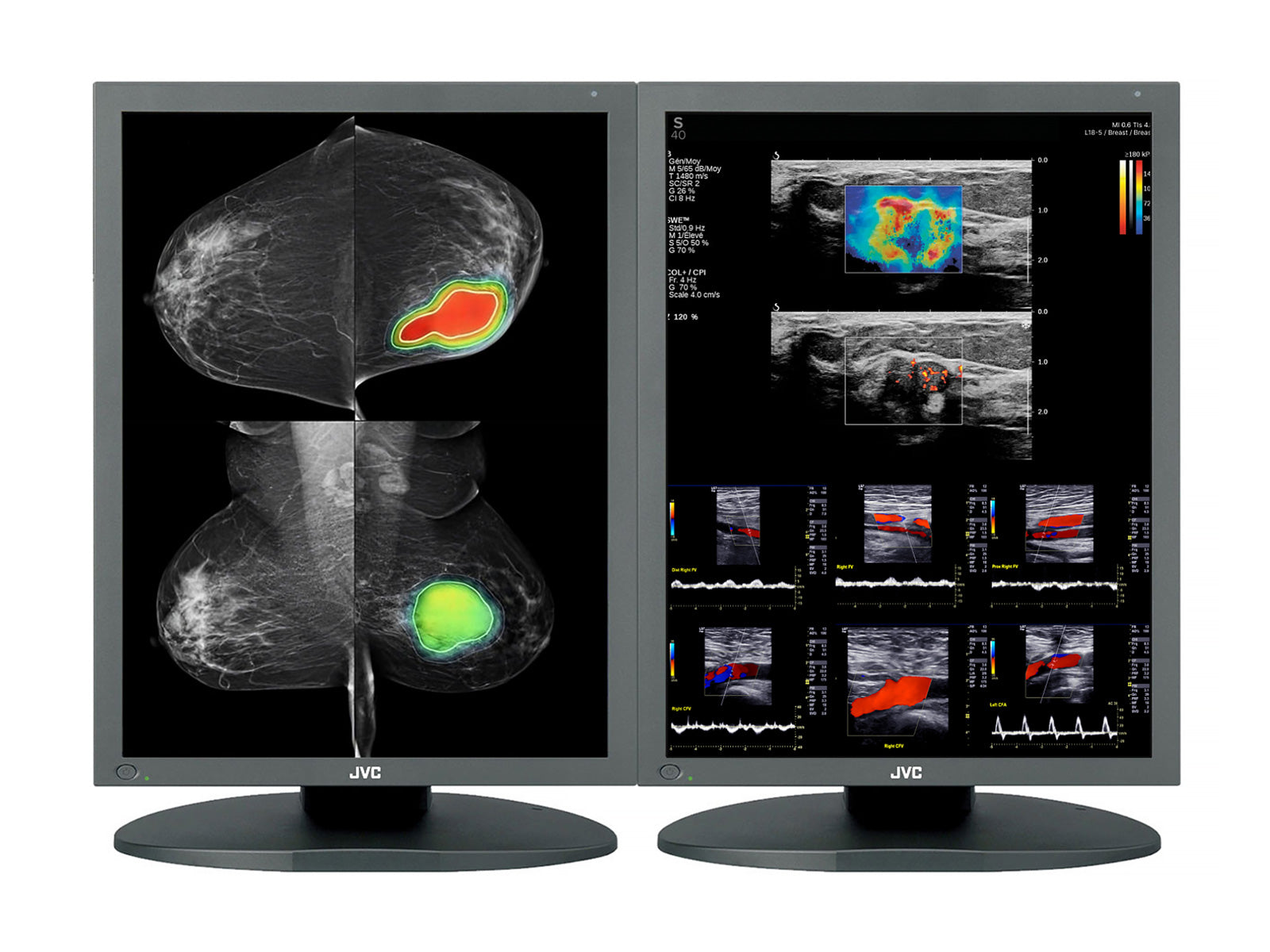 JVC Totoku CCL550i2 5MP 21" Color LED Mammo 3D-DBT Breast Imaging Display (CCL550i2)