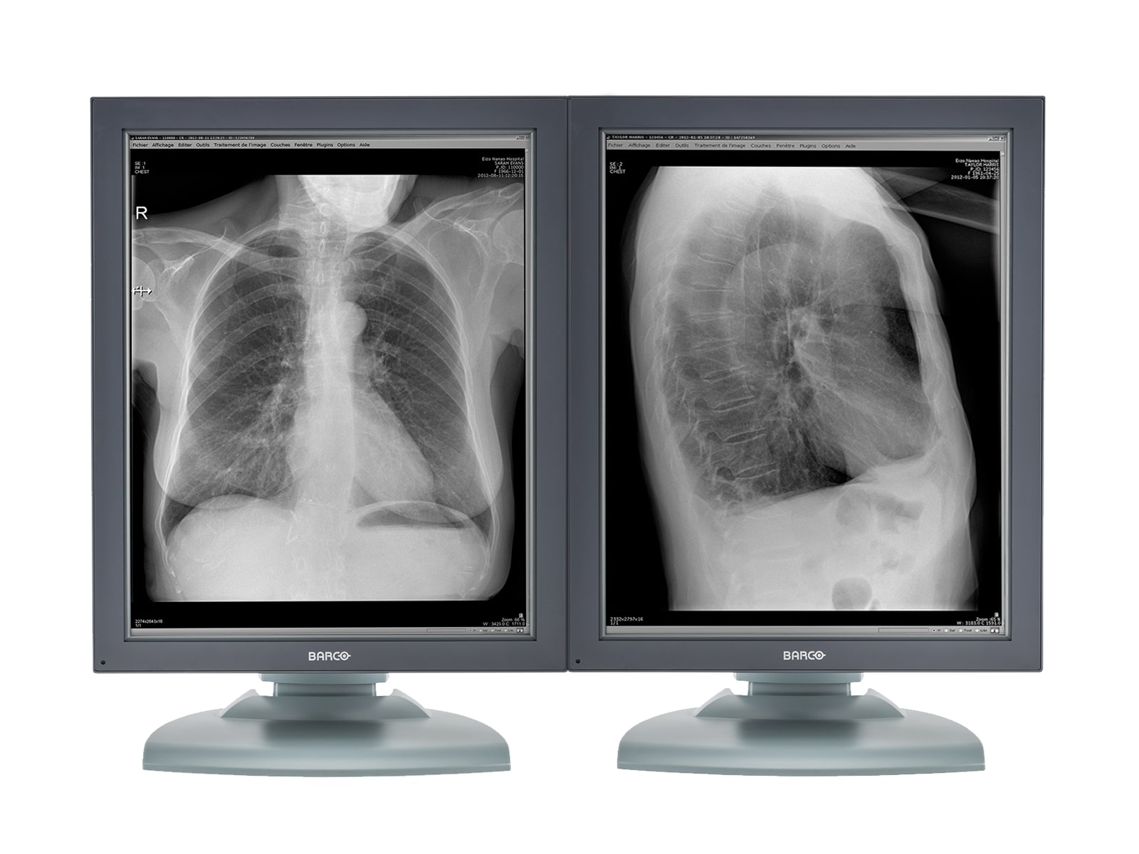 Barco Nio MDNG-2121 2MP 21" Grayscale Medical Diagnostic Radiology Monitor