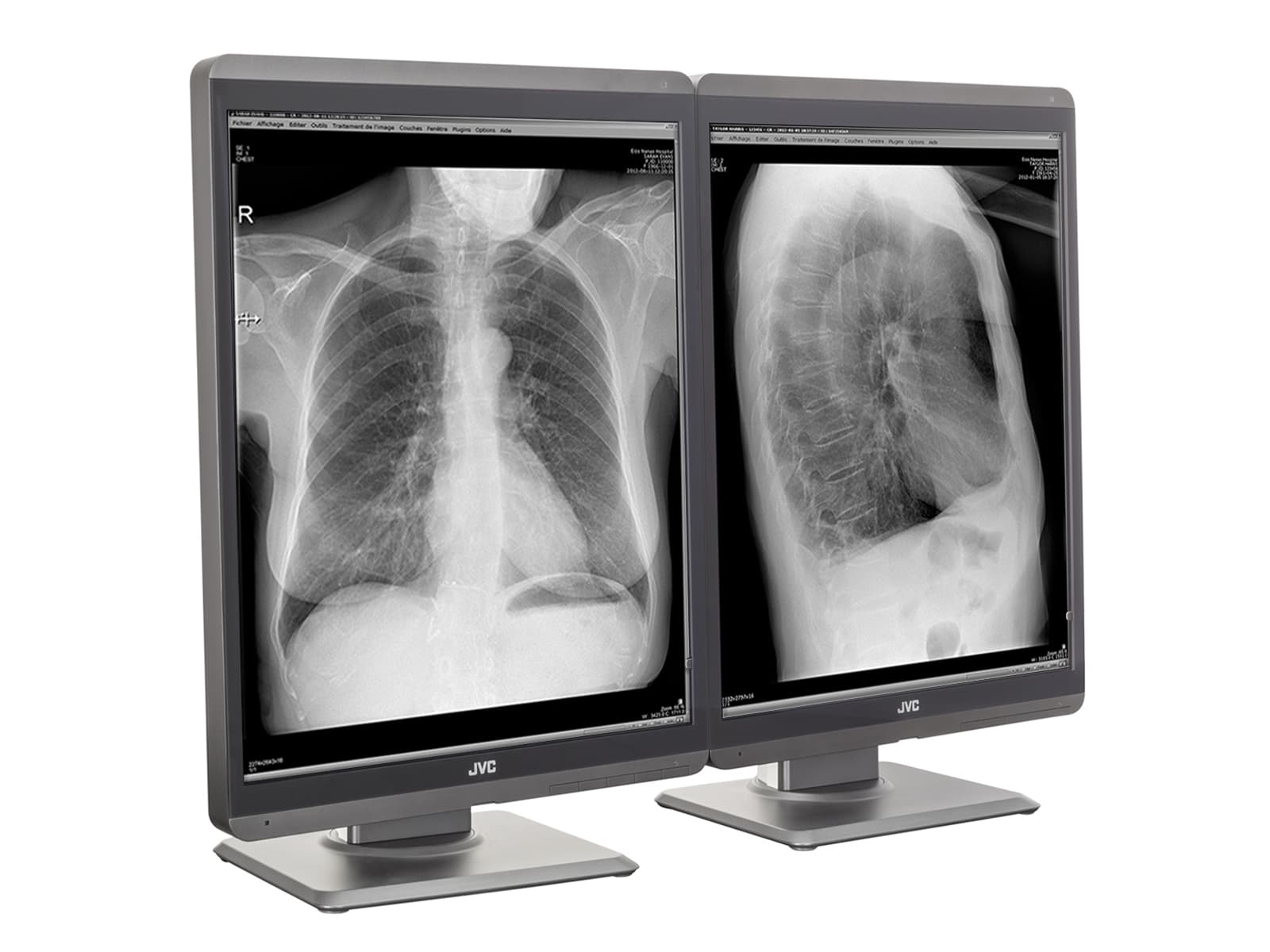 JVC Totoku MS-S300 3MP 21" LED Grayscale General Radiology Diagnostic Display Monitor (MS-S300)