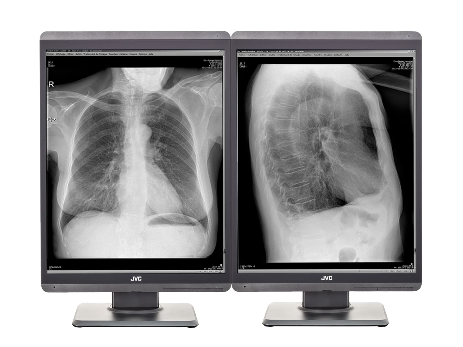 JVC Totoku MS-S300 3MP 21" LED Grayscale General Radiology Diagnostic Display Monitor (MS-S300)